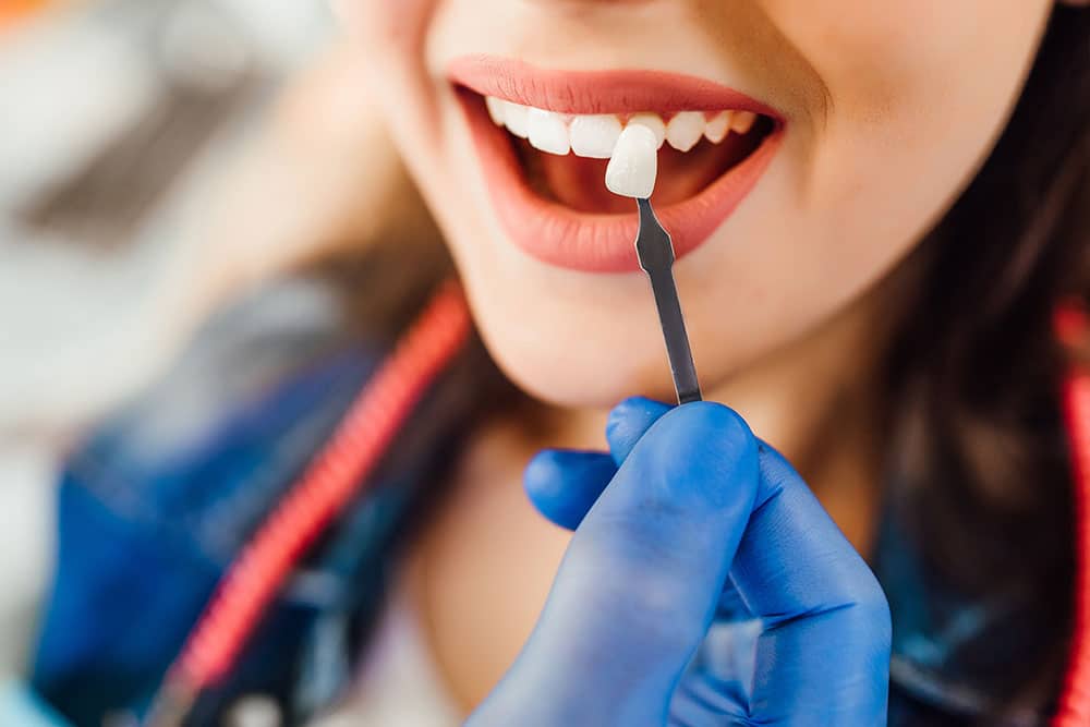 Matching tooth color